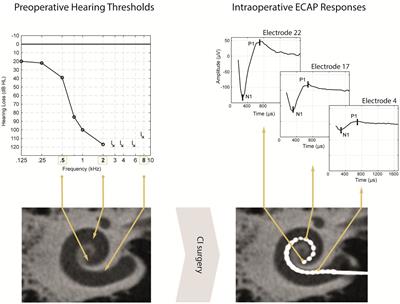 Electrically evoked compound action potentials in cochlear implant users with preoperative residual hearing